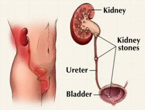 COSMODIC Therapy: Kidney Stones and Gallstones